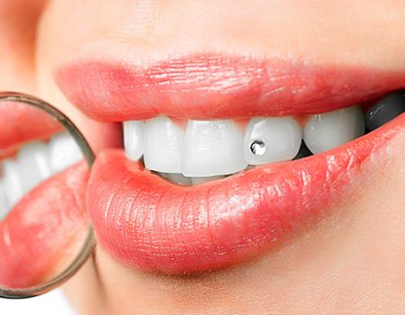 joyeria dental y brillante en el diente