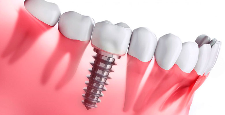 clinica implantes dentales sevilla