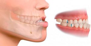 Maloclusión dental en Sevilla