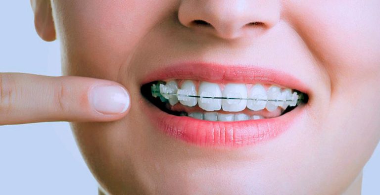 oferta ortodoncia invisible