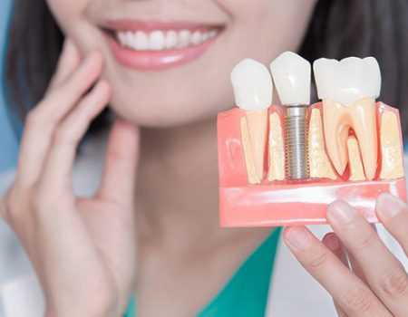 preguntas frecuentes implantes dentales