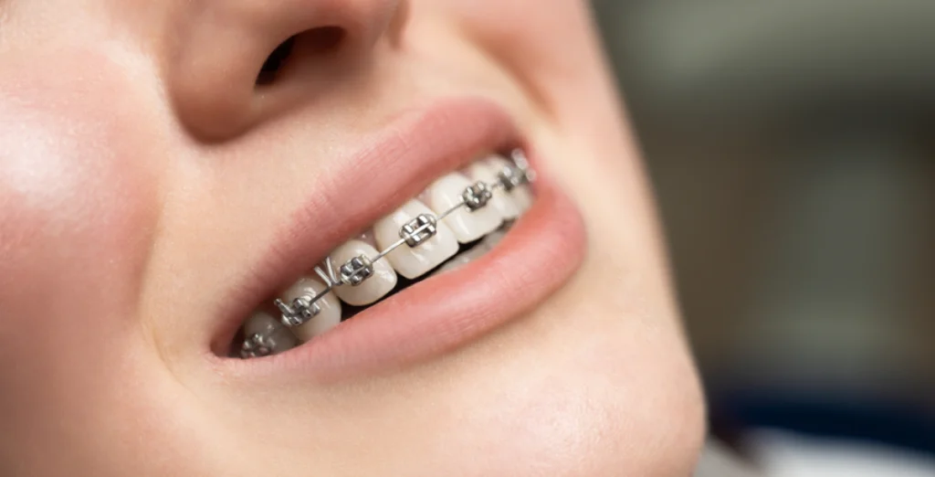 Ortodoncia: Brackets metálicos