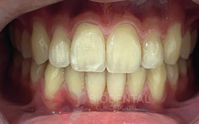 manchas blancas en los dientes sevilla