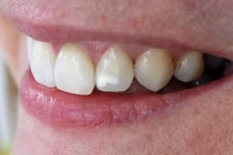 como quitar manchas blancas en los dientes