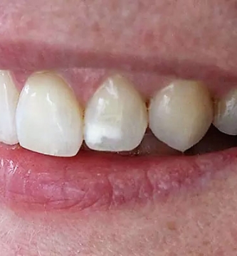 como quitar manchas blancas en los dientes