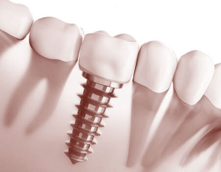 implantes dentales sevilla