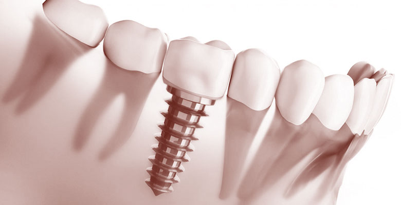 implantes dentales sevilla
