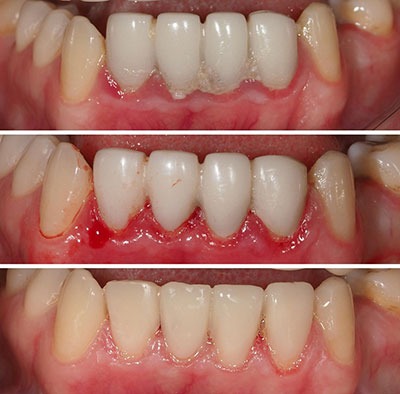 Antes y despues de un caso de carillas inyectadas de composite en sevilla