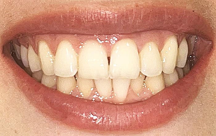 antes invisalign sevilla