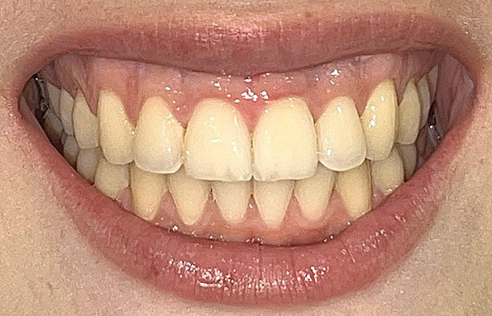 despues invisalign sevilla