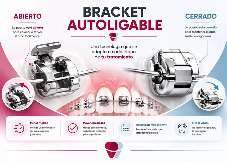 funcionamiento del bracket autoligable