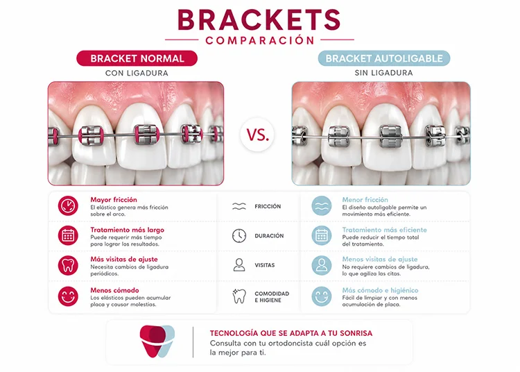 comparativa brackets metalicos y autoligables