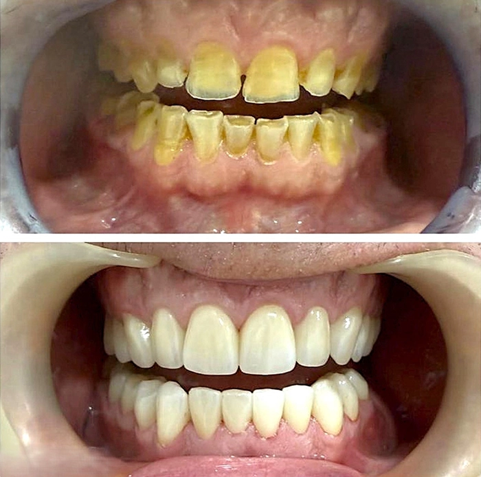 Caso real de implantes dentales y rehabilitación completa antes y después en Sevilla