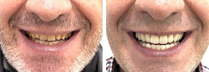 Resultado de sonrisa antes y después tras rehabilitación oral con implantes y coronas de circonio en Sevilla